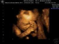 BABY SCAN DETAILS, nottingham ultrasound items in WINDOW TO THE WOMB 