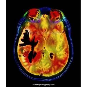  Coloured MRI scan of a metastatic brain tumour Framed 
