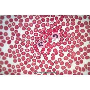  LM of human blood smear showing red and white cells Canvas 